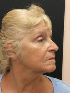 After Image: Perfect Derma Peel