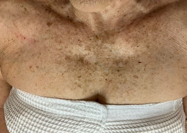 Before Image: Laser Rejuvenation - front