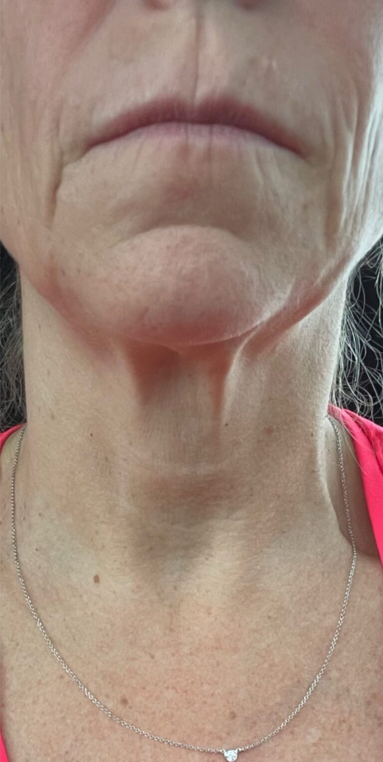 Before Image: Matrix Pro RF Applicator Chin and Jaw Area - front